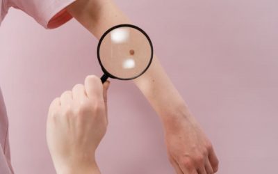 Na czym polega chirurgiczne usuwanie zmian skórnych?